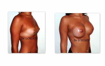 Photo-augmentation-mammaire-avant-apres-300cc