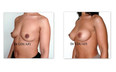 Photo-augmentation-mammaire-avant-apres-325cc