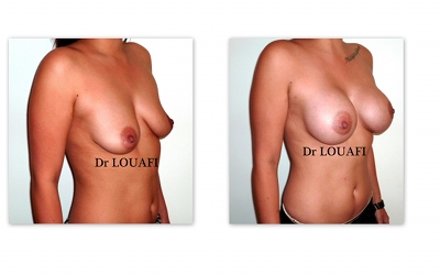 Photo-augmentation-mammaire-avant-apres-350cc