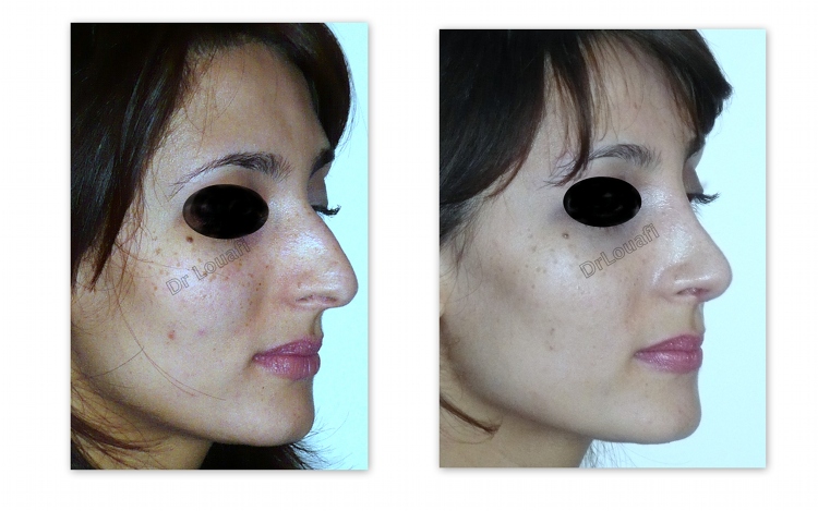Rhinoplastie Paris