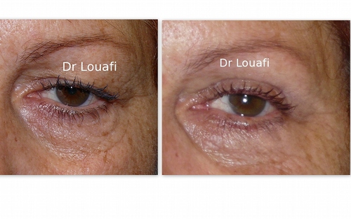 Blepharoplastie Paris
